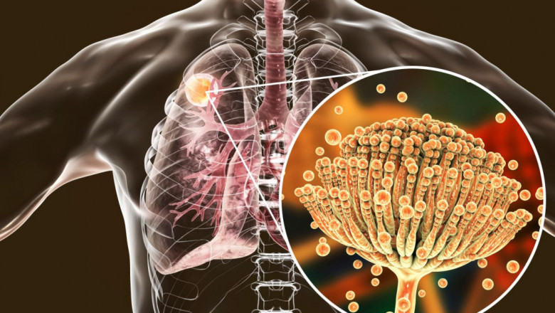 Global Aspergillosis Treatment Market Analysis