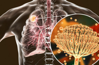 Global Aspergillosis Treatment Market Analysis