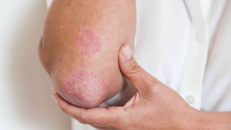 Actinic Keratosis Market: A Deep Dive Analysis Of Various Regions And Strategies During Forecast Period 2021 – 2028