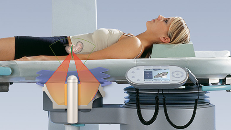 Chile Extracorporeal Shock Wave Lithotripsy Market Industry Insights, Trends, and Forecasts to 2027