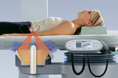 Chile Extracorporeal Shock Wave Lithotripsy Market Industry Insights, Trends, and Forecasts to 2027