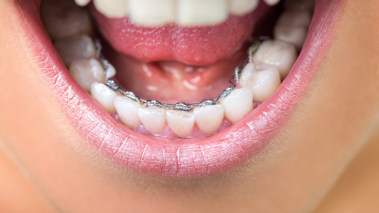 What Are The Fascinating Aspects Of Lingual Braces?