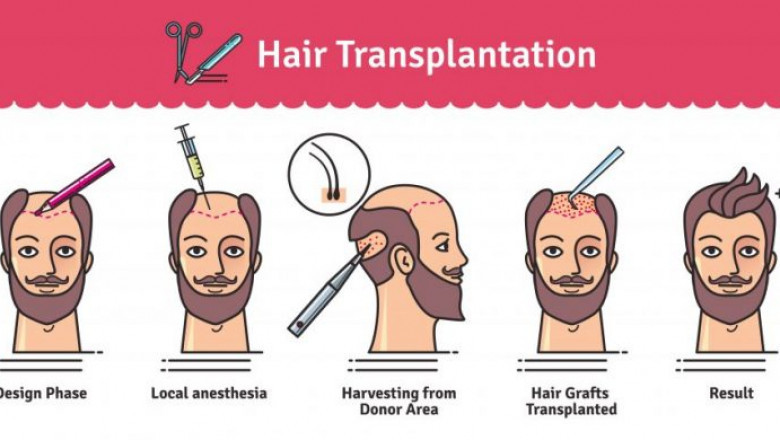 Best hair transplant Clinic in Chandigarh