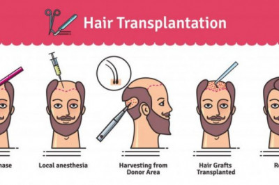 Best hair transplant Clinic in Chandigarh
