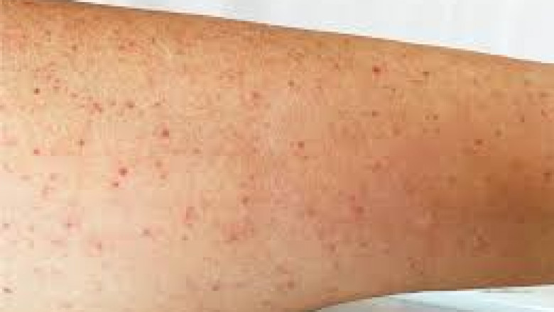 Immune Thrombocytopenia Market | Global Industry Trends, Segmentation, Business Opportunities & Forecast To 2028