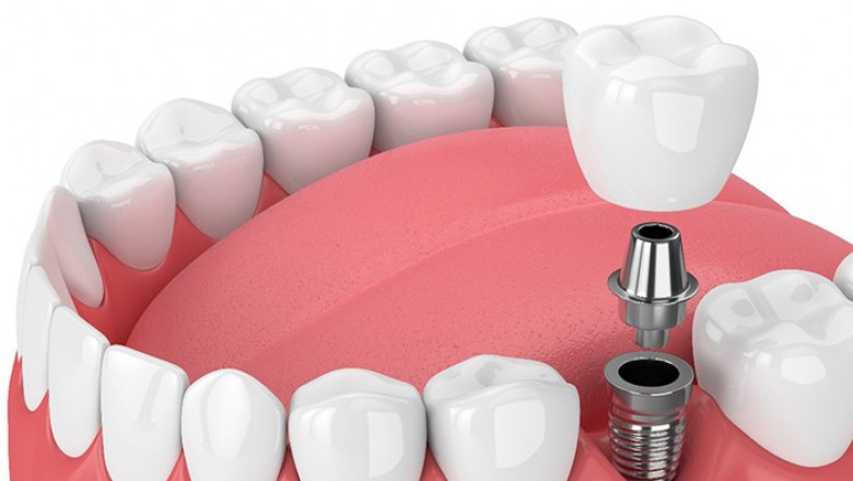 Understanding single dental implants