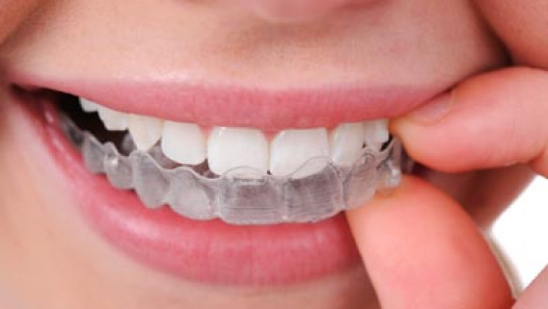What Are the Advantages of a Root Canal?