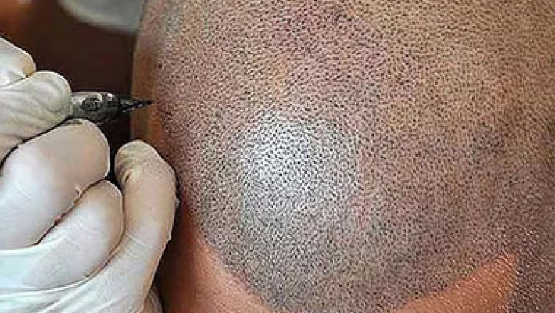3 Ways PRP Hair Treatment in Bangalore Can Change Your Life