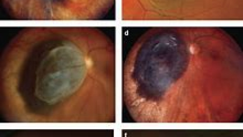 Uveal Melanoma Treatment Market Trends, Analysis by Top Key Player and Forecast till 2028