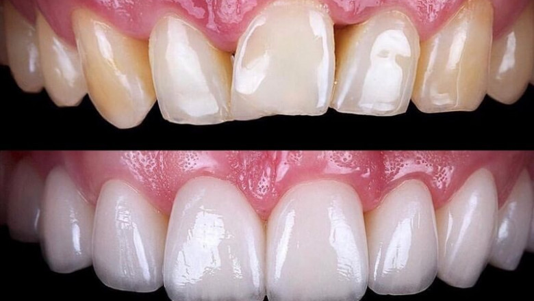 What Should You Consider From Full Mouth Veneers?