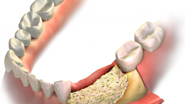 A Variety Of Advanced Dental Implant Surgical Techniques Including Dental Bone Graft And Substitutes Have Made Dental Implant Surgery Increasingly Popular