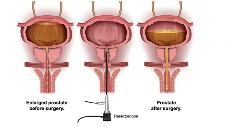 In Benign Prostatic Hyperplasia Surgical Treatments, The Prostate Gland Is Used To Treat Urinary Issues