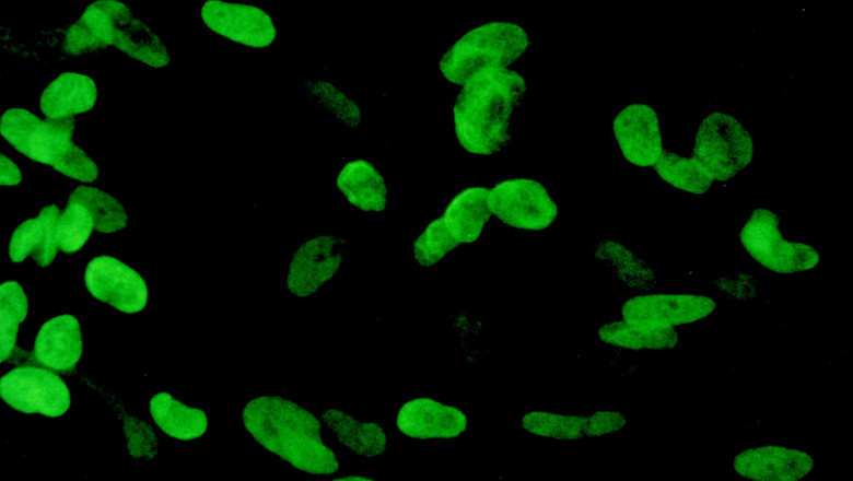 What is the Cytomegalovirus (CMV) Infection Treatment and Diagnosis?