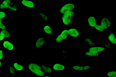 What is the Cytomegalovirus (CMV) Infection Treatment and Diagnosis?