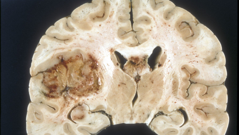 Glioblastoma Multiforme Treatment Market Research Report - Competitive Analysis and Forecast period during 2022-2027