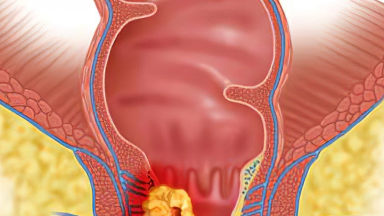 Global Anal Cancer Market Analysis