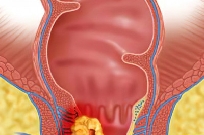 Global Anal Cancer Market Analysis