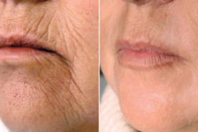 Fibroblast Plasma Training