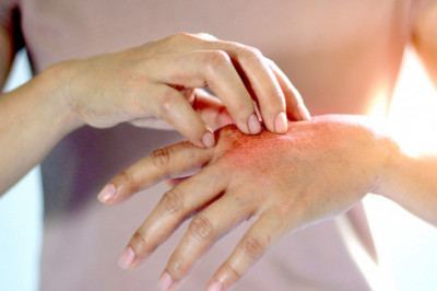 Global Psoriasis Treatment Market Overview