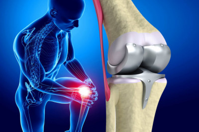 Knee Replacement Is the Most Effective Way to Relieve Your Pain