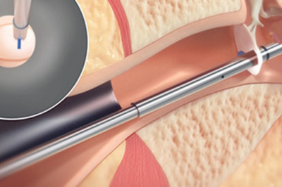 Tympanostomy Products Products Are Intended To Aid In The Removal Of Earwax