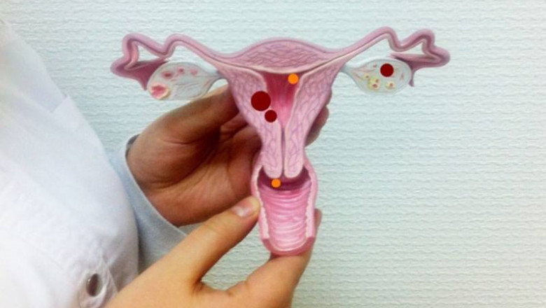 Cervical Dysplasia Market- Regional Analysis and Insights during the Forecast Period 2020-2027