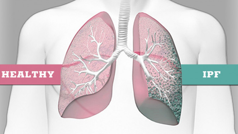 Idiopathic Pulmonary Fibrosis Treatment Symptoms and Progression
