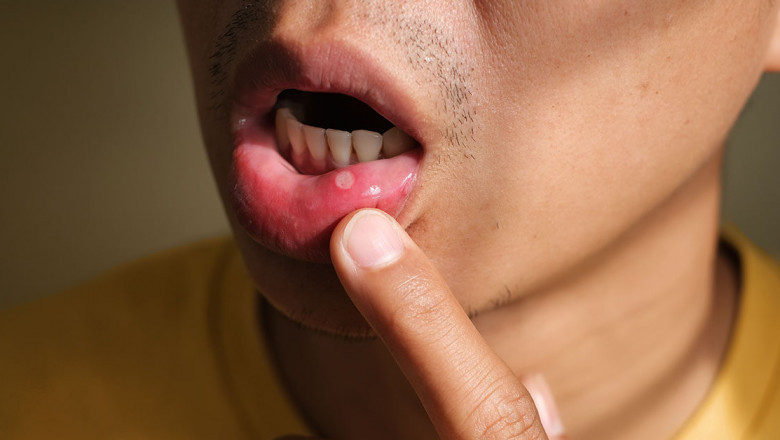 Mouth Ulcer Treatment: Bruises, Sores, Or Lesions Of The Soft Tissues Of The Oral Cavity Are Called Mouth Ulcers