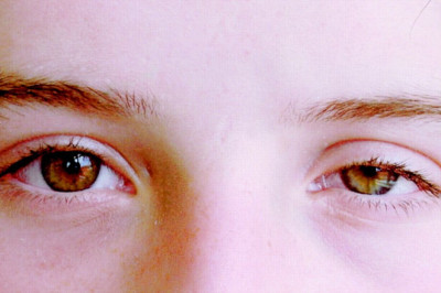 What Exactly is Behcet's Syndrome