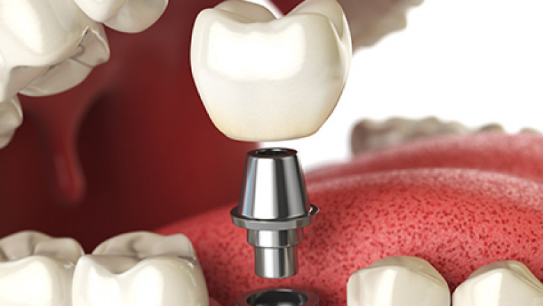What Dental Implants Are Durable Treatments?