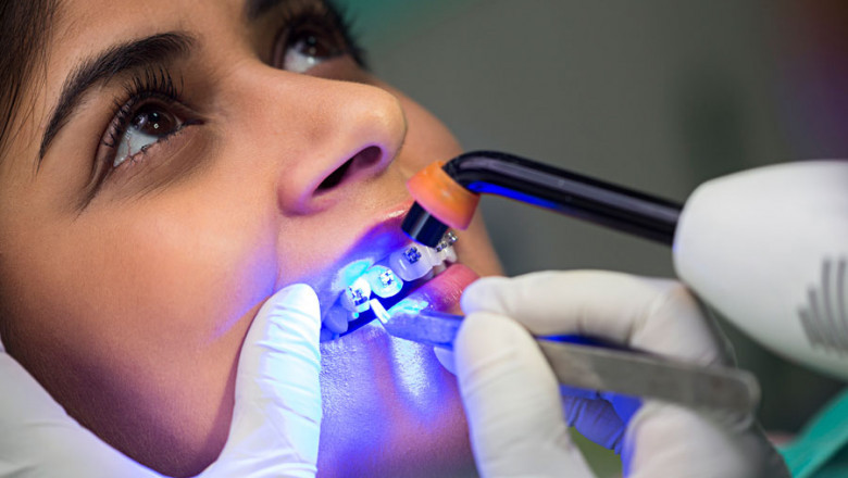 MYTHS AND FACTS ABOUT TEETH BRACES | ORTHODONTIST IN GURGAON