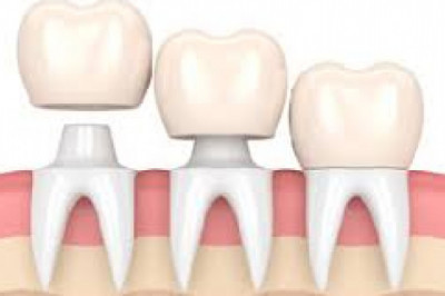 Everything you need to know about DENTAL CROWNS | Dentist in Gurgaon - The Dental Home