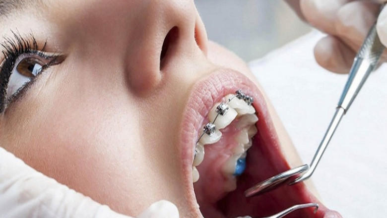 Why Does Orthodontic Treatment Matter For Adults?