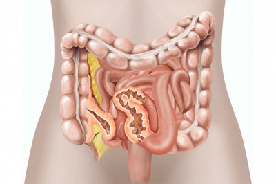 Things to know about the Ulcerative Colitis