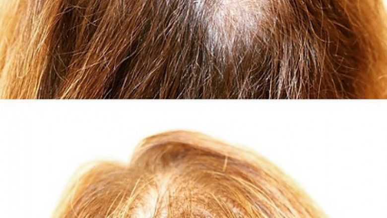 Best Prp Treatment In Edmonton CA | Balwin Aesthetics