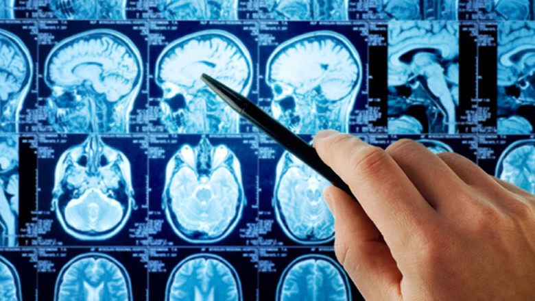 Adult Malignant Glioma Therapeutics Market Size, Share, Trends & Forecast 2029
