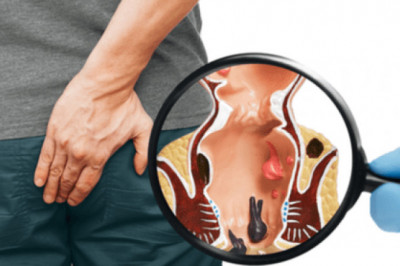 Get The Right Treatments For Piles In Navi Mumbai!