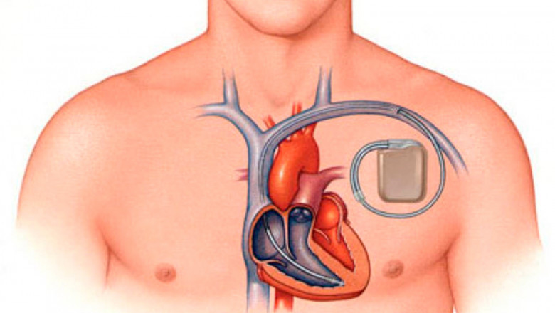 Pacemakers have been widely used to treat bradycardia with Implantable Cardiac Pacemaker