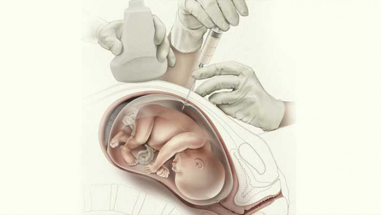 A Prenatal Diagnostic Test For A Child Involves The Use Of Amniocentesis Needles For Detectable Sampling