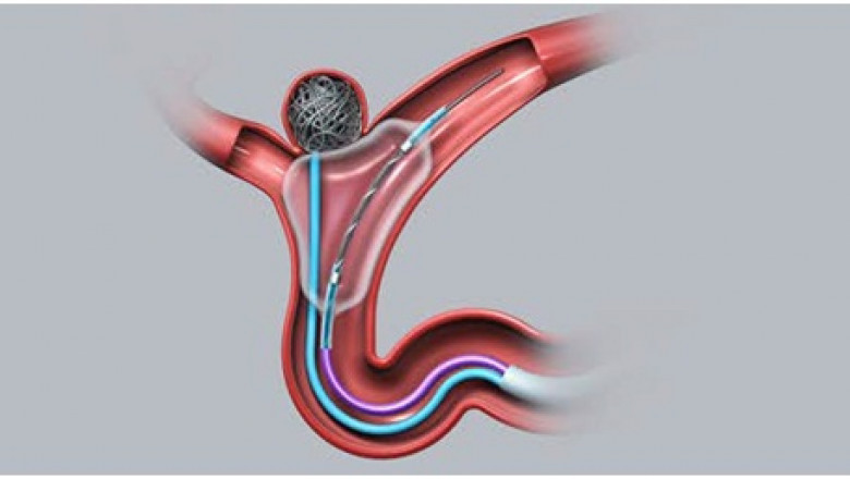 A study of the global Intracranial Stents Market: trends, market size, growth, opportunity, as well as forecasts for 2026