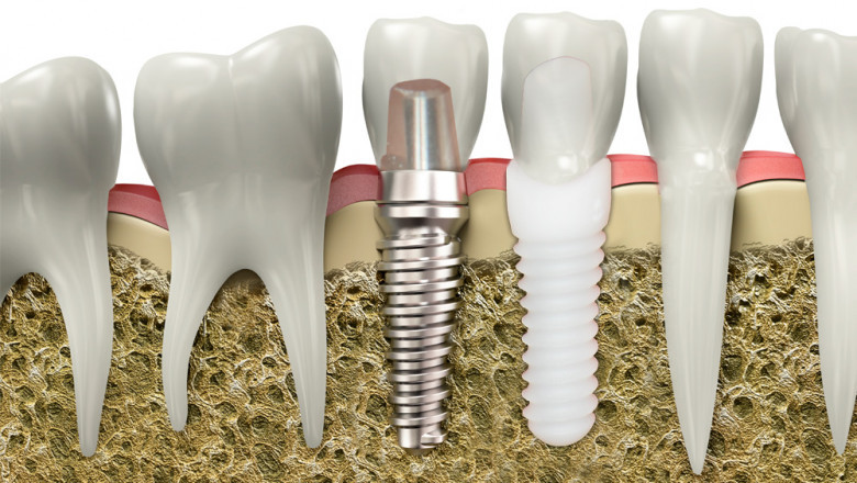 After Surgery, Bioimplants Can Be Used To Treat Skin Burns Or Sores Of The Skin