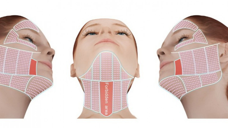 Know the Types of Non-Surgical Skin Tightening Treatments