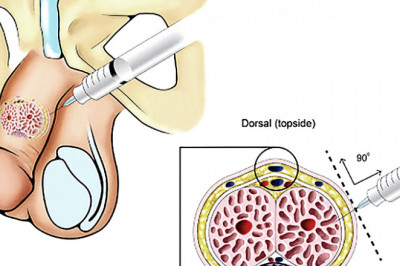 2 Reasons to choose Erectile Dysfunction Treatment in Kuala Lumpur