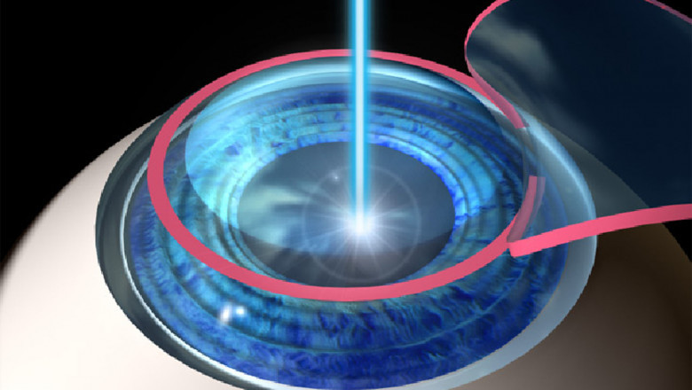 Measurement of Refraction Status Through Wavefront Aberrometers