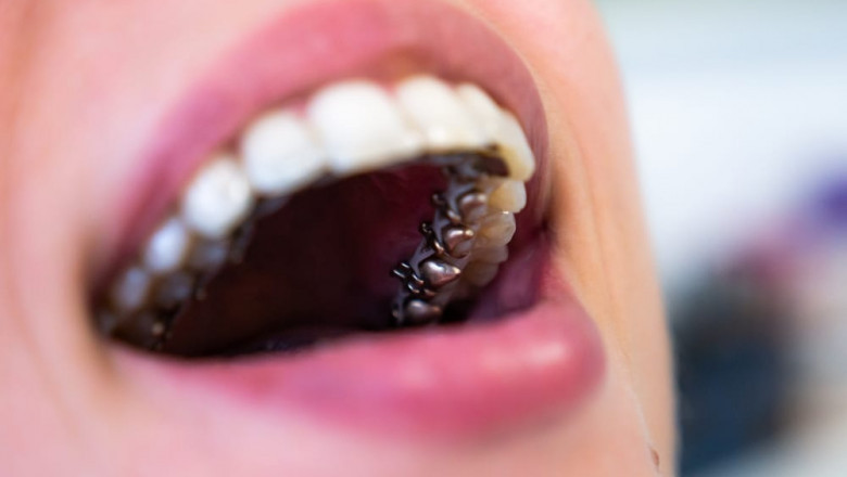 What Are the Upside and Downsides of Braces?