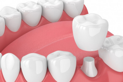 Are Dental Implants Good for Young Adults?