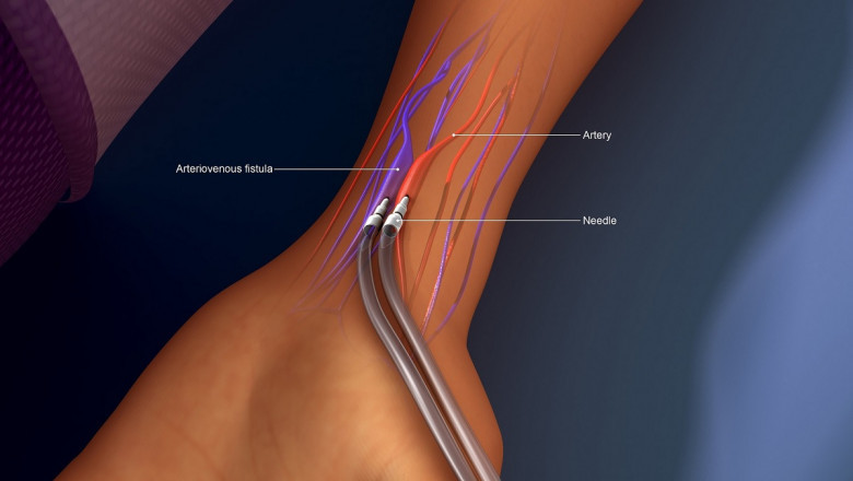 Creating an Arteriovenous Fistula for Hemodialysis