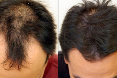 Hair Loss Treatment - The Top 3 Treatments That Actually Work