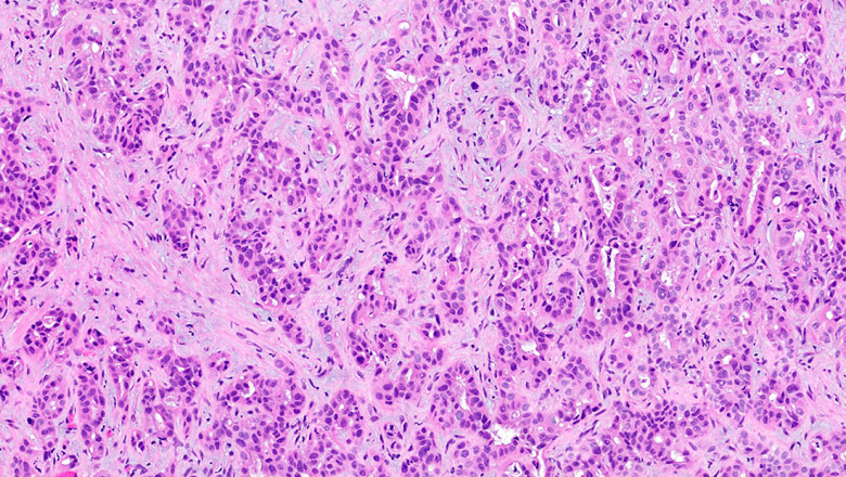The Slender Tubes That Carry Bile, The Digestive Fluid, Can Develop Cholangiocarcinomas