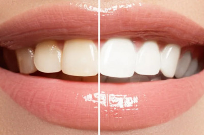 Professional Teeth Whitening | IPSC - Interventional Pain and Spine Center